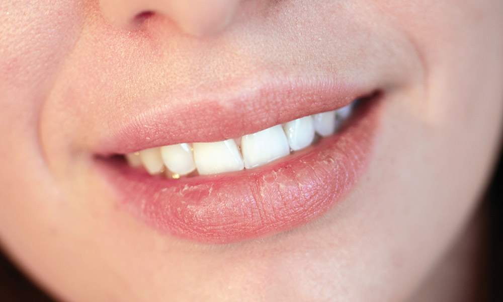 Dry Lip Treatments: 3 Ways to Treat Your Client’s Chapped Lips ...