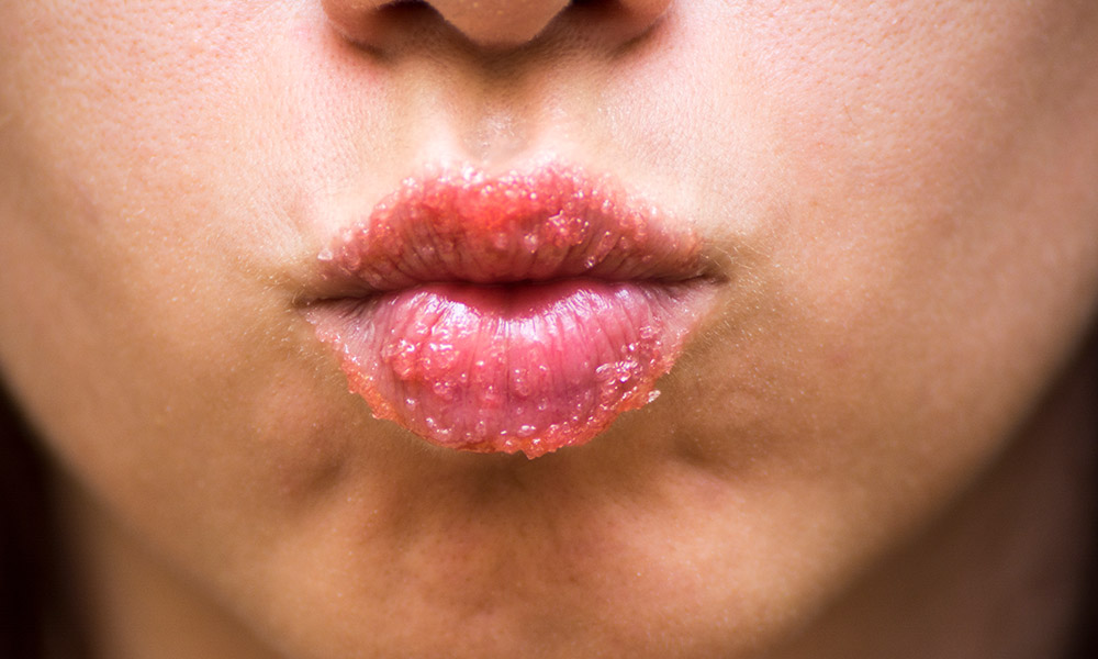 Dry Lip Treatments 3 Ways to Treat Your Client’s Chapped Lips